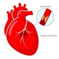 Ischemic Heart Disease